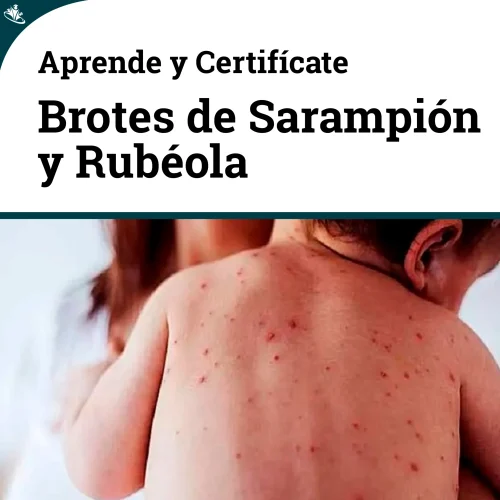 Curso Respuesta Rápida a Brotes de Sarampión y Rubéola Curso Respuesta Rápida a Brotes de Sarampión y Rubéola