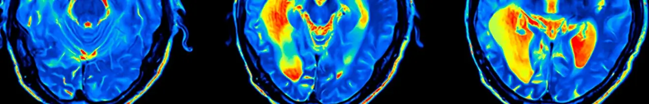 Curso en Manejo Integral del Paciente con Accidente Cerebrovascular (ACV) – Colombia